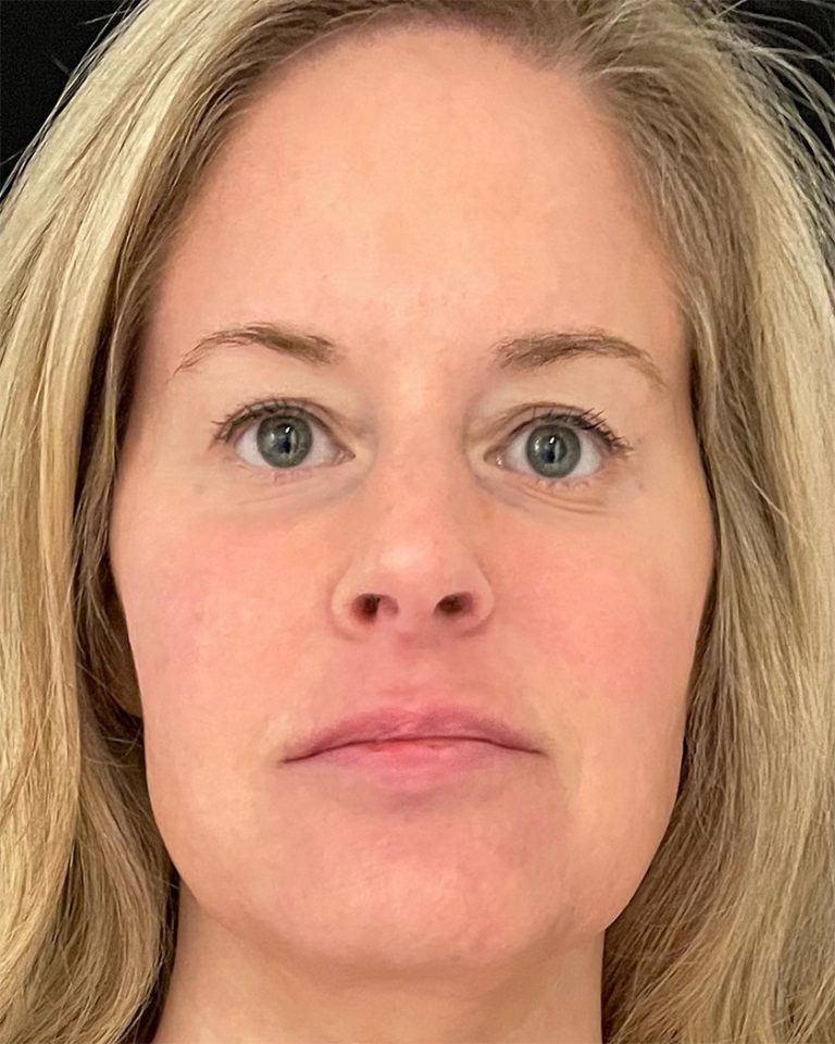 An after EmFace procedure example for U.S. Bodycontour & Wellness Center in Iowa City, IA.