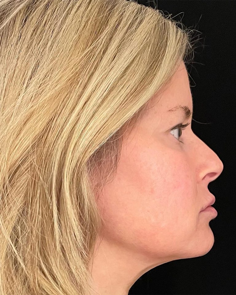 A before EmFace procedure example for U.S. Bodycontour & Wellness Center in Iowa City, IA.