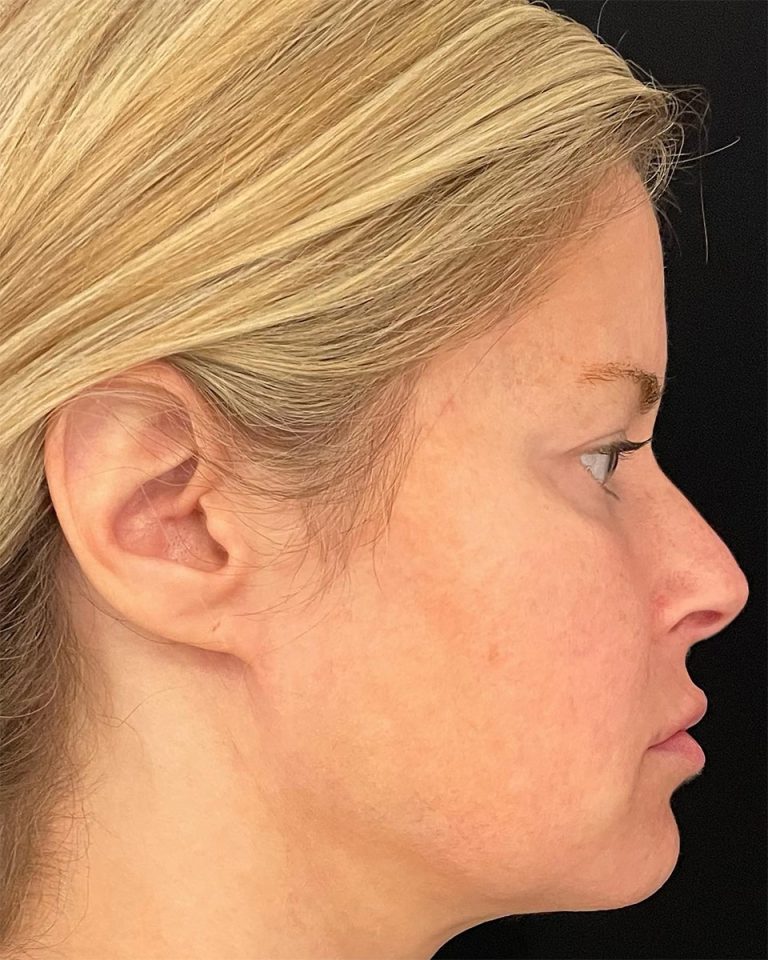 An after EmFace procedure example for U.S. Bodycontour & Wellness Center in Iowa City, IA.