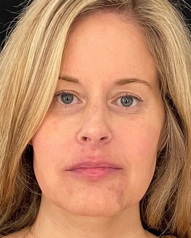 A before EmFace procedure example for U.S. Bodycontour & Wellness Center in Iowa City, IA.