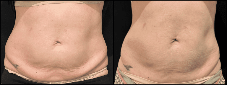 Before and after examples of Body contouring services at U.S. Bodycontour & Wellness Center in Iowa City, IA.